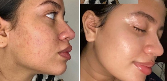 Before and after using vitamin C serum.