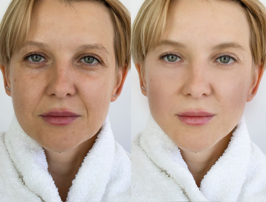 Before-after analysis: Skin Rejuvenation