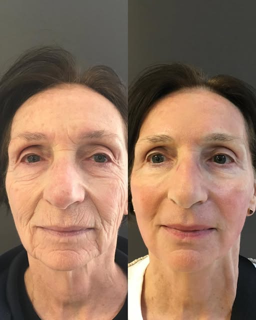 Deep peeling; one session result