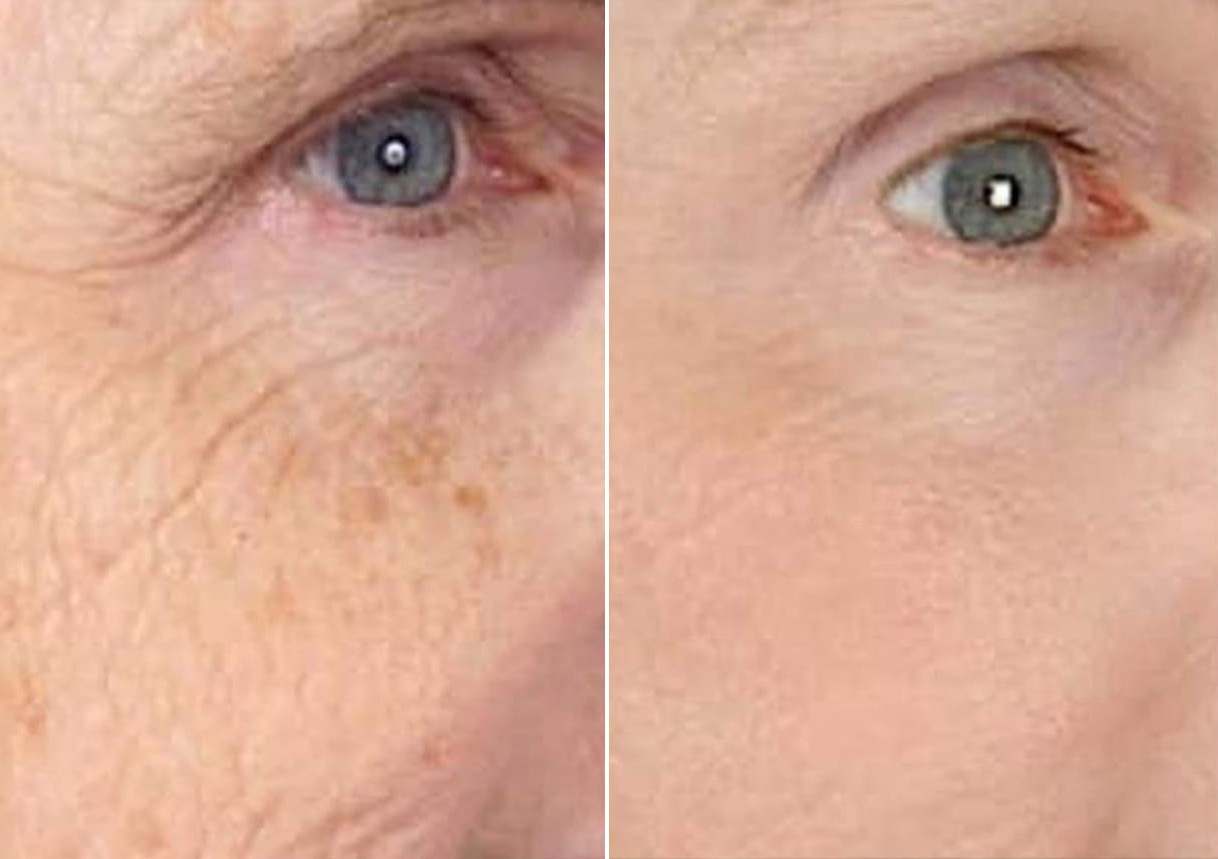 Antiwrinkle serum, 3% retinol.  Spoiler: retinol apparently also does a blepharoplasty