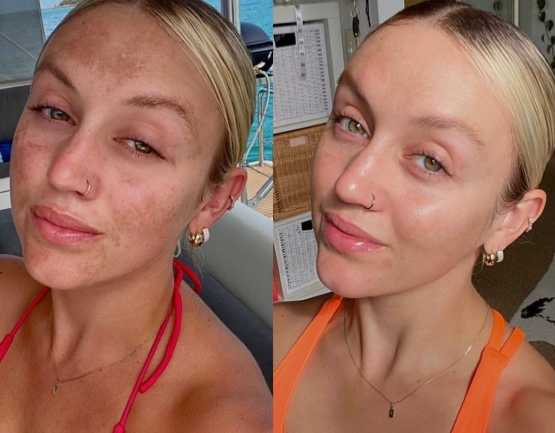 Six-week transformation using Radiance Reset cleanser, Luminosity, and Dream Cream — addressing pigmentation and congestion