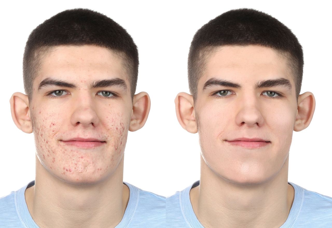 Before-after analysis: Retouched acne Before/After image