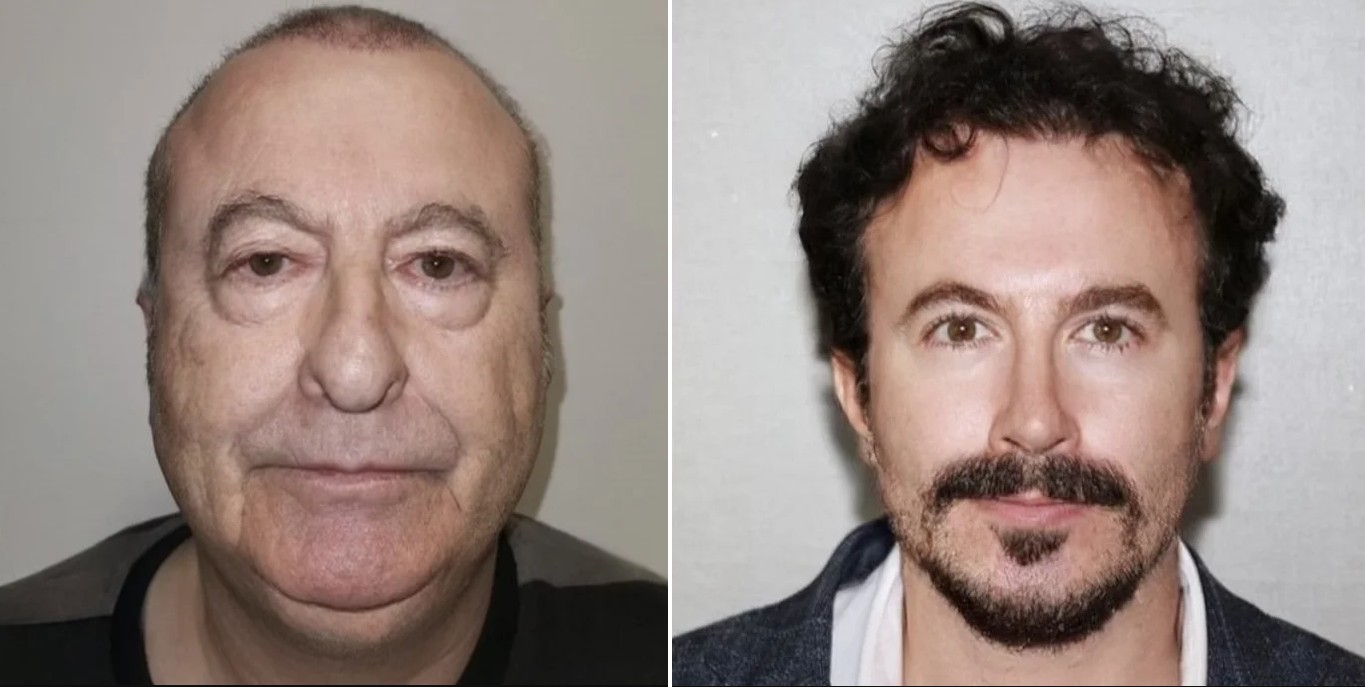 This "Hair transplant result" is actually two different people!