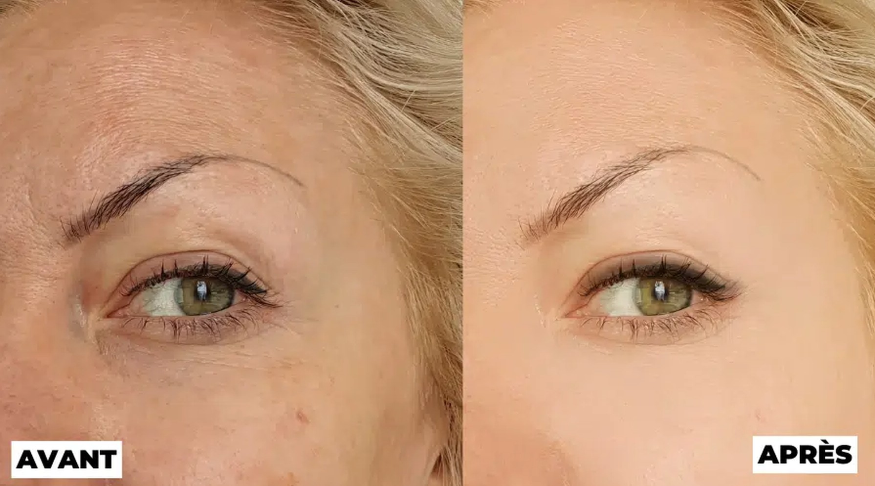 RF result before and after. Didn't even try.